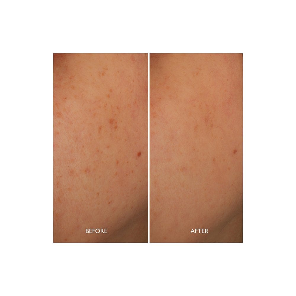 Age Benefit™ Hyperpigmentation Repair