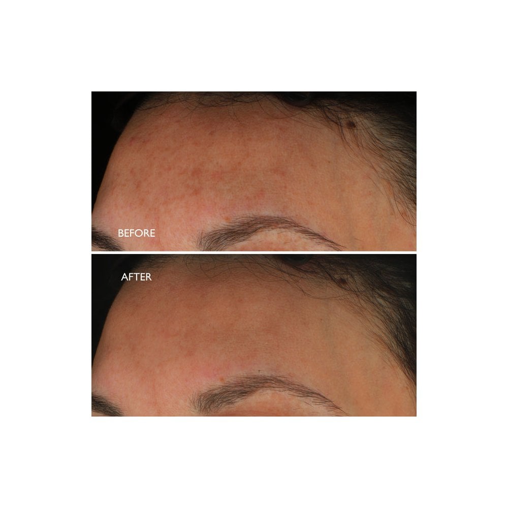 Age Benefit™ Hyperpigmentation Repair