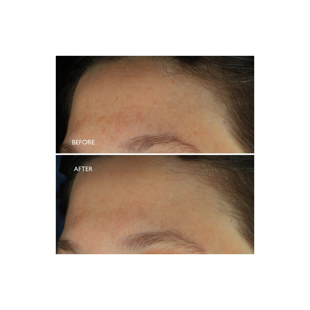 Age Benefit™ Hyperpigmentation Repair